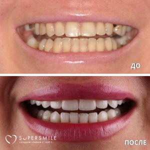 До/После №14328