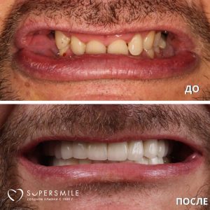 До/После №14330