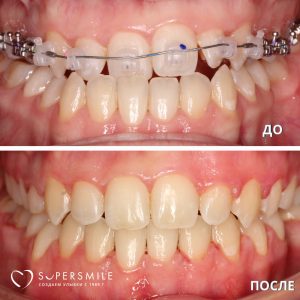 До/После №14342