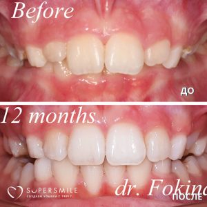 Брекеты (до/после)