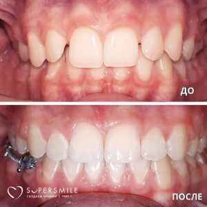 Исправление прикуса (до и после)