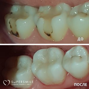 Чистка/терапия (до/после)