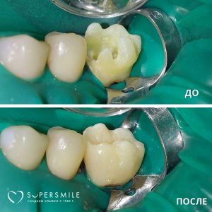 Функциональная реставрация моляра после эндодонтии (до/после)