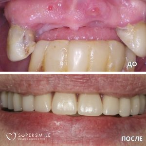 Имплантация All on 4 (до/после)