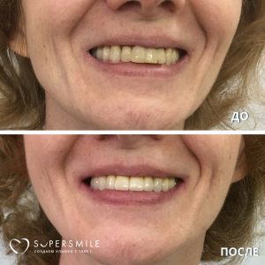 Имплантация/Протезирование (до/после)