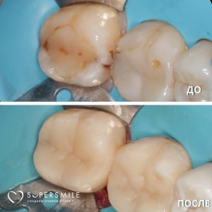 Лечение кариеса