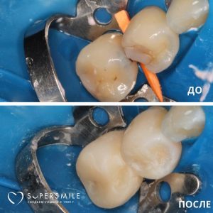 Лечение кариеса