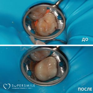 До / После лечения кариеса зуба