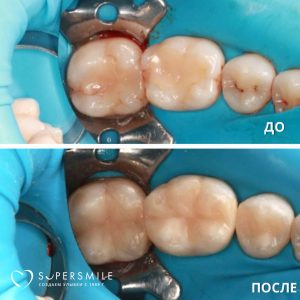 До / После лечения кариеса зубов