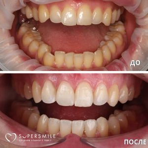 Исправление прикуса и скученности зубов