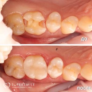 Кариес не ждёт — а мы умеем его останавливать вовремя.