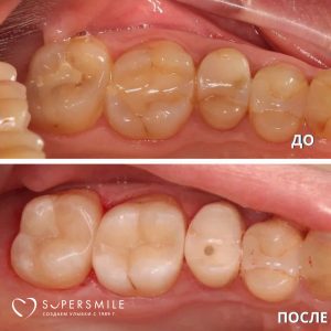 Лечение кариеса и замена старых пломб