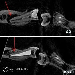 Лечение хронического периодонтита