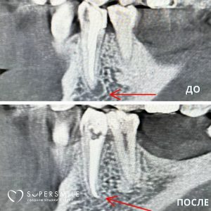 Казалось — просто «побаливает иногда». А внутри — хронический периодонтит.