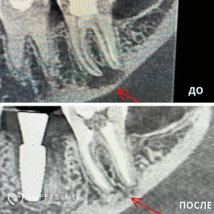 Сохранили 37 зуб — хотя уже казалось, что поздно.