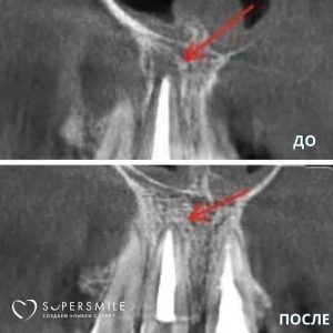 Когда воспаление прячется прямо в центре улыбки