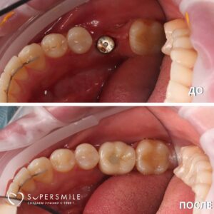 Имплантация отсутствующего 36 зуба