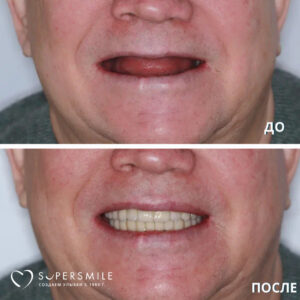 Нижняя челюсть — протезирование по системе Все на 4, верхняя челюсть — восстановление по системе Все на 6