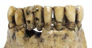 История имплантации зубов