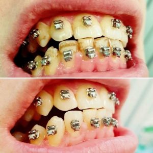 Терапевтическое лечение/гигиена/отбеливание (до/после)