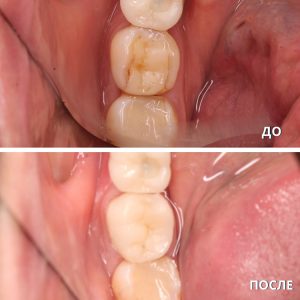 Протезирование зубов (до/после)