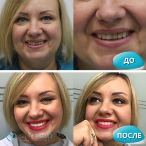 Имплантация зубов / протезирование (до и после)