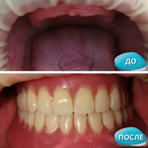 Протезирование зубов