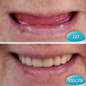 Имплантация зубов / протезирование (до и после)