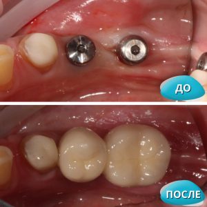 Коронки на имплантаты (до/после)