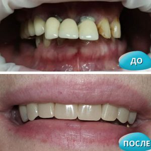 Имплантация All on 4 (до/после)