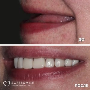 Имплантация и протезирование