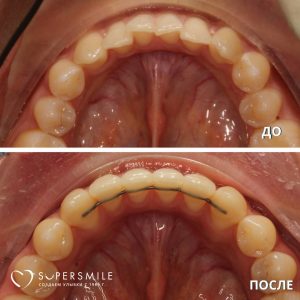 Исправление скученности зубов