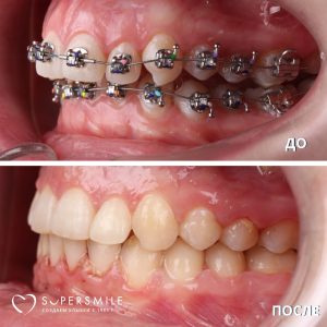 Лечение брекетами