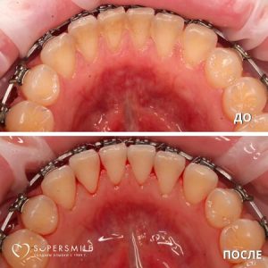 Профессиональная гигиена (до/после)