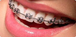 Виды и особенности современных брекет-систем