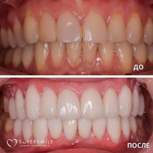 Установка виниров (до/после)