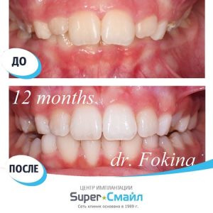 Брекеты (до/после)