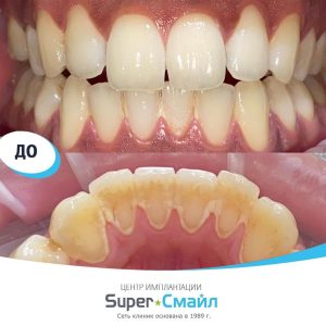 Чистка/терапия (до/после)