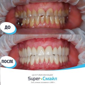 Имплантация и виниры (до/после)