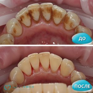 Профессиональная гигиена (до/после)