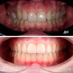 Комплексный план лечения (до/после)