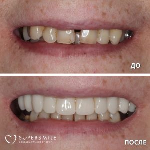 До/После №7153