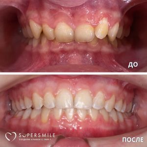 Лечение глубокого прикуса