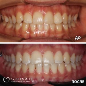 Исправление скученности зубов