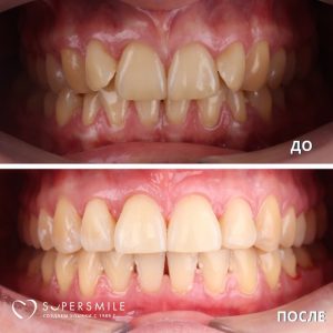 Ортодонтическое лечение на брекетах.