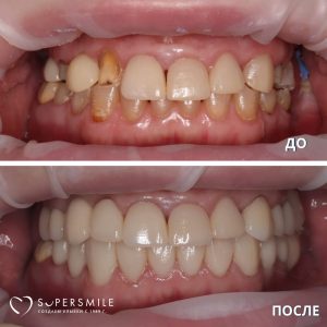 Имплантация зубов (до/после)