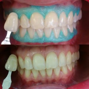 Терапевтическое лечение/гигиена/отбеливание (до/после)