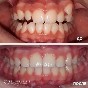 Исправление прикуса (до/после)