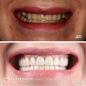 Тотальное протезирование зубов — комплексный план лечения