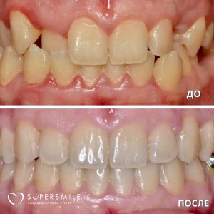 Исправление перекрестного прикуса